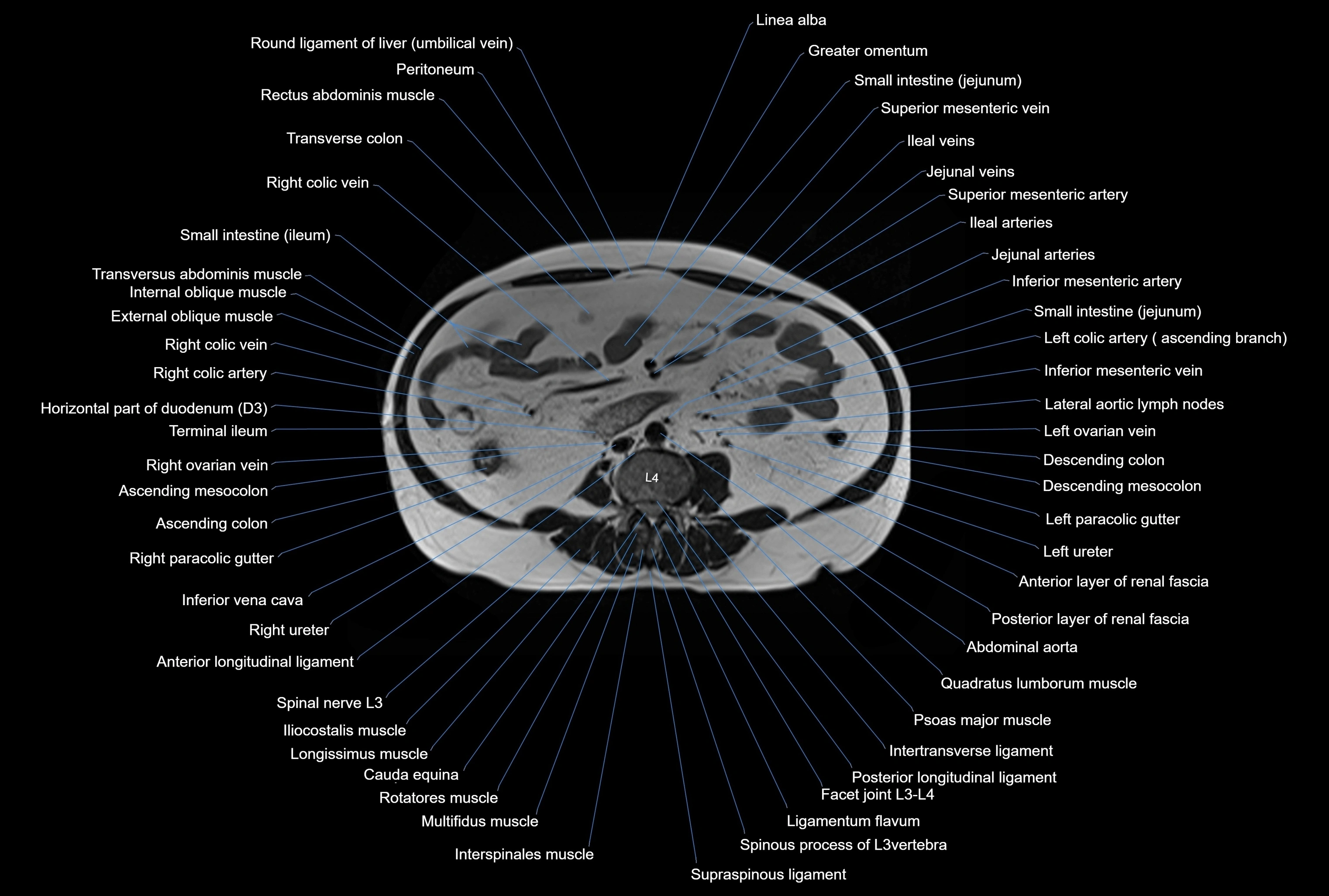 MRI Abdomen axial cross sectional anatomy radiology  image-img-00001-00029.webp